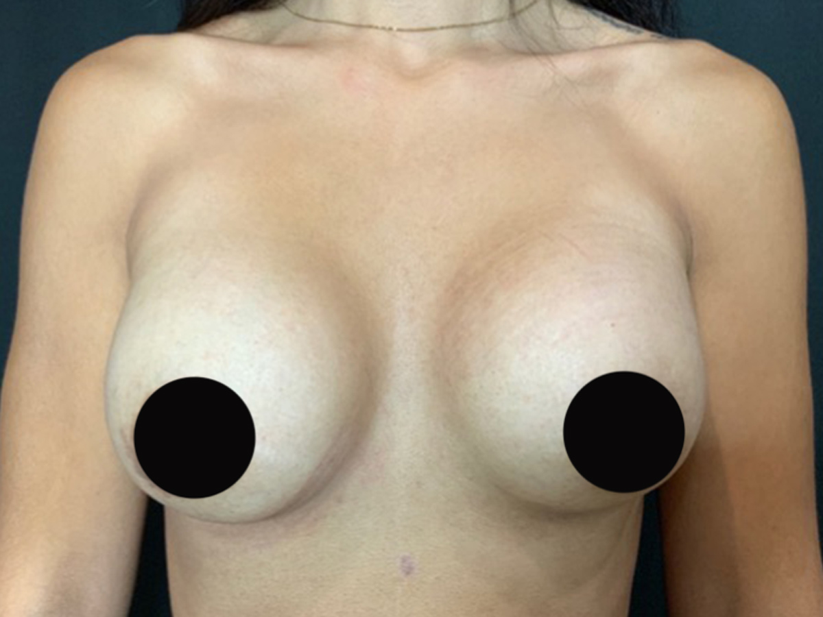 Case--2758 | After Breast Augmentation