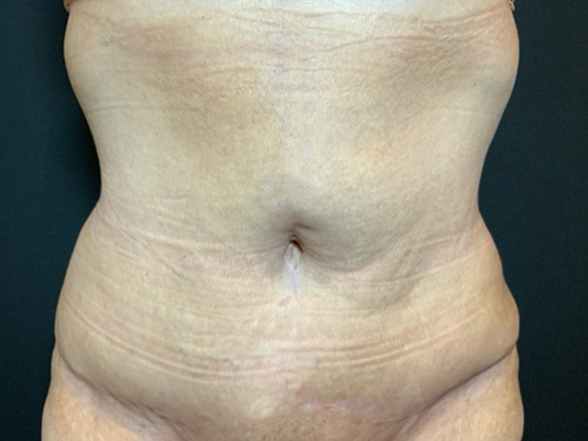 Case--2683 | After Fleur de Lis