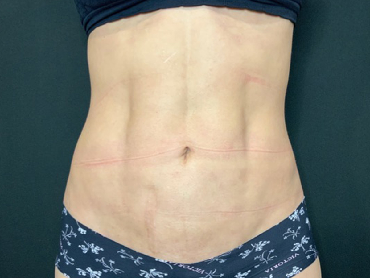 Case--1510 | After Liposuction