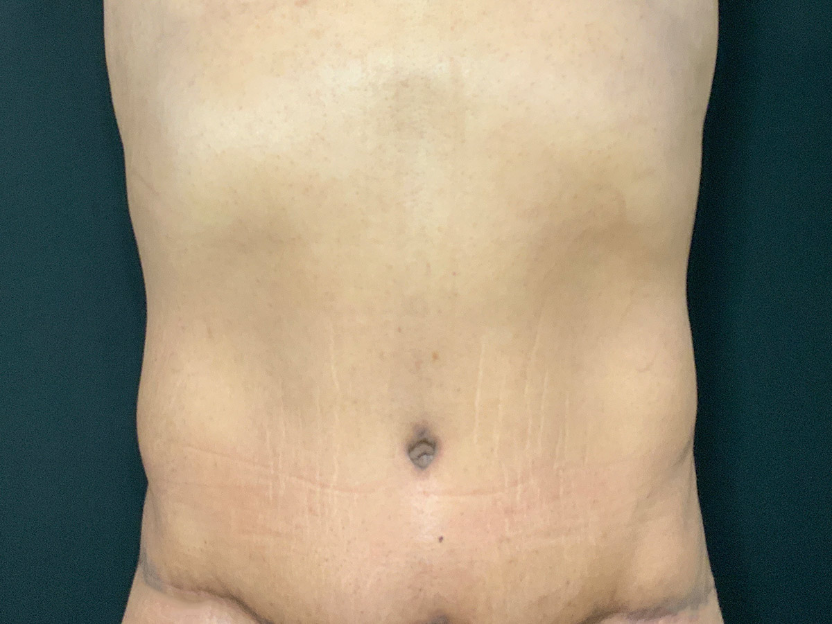 Case--4828 | After Male Tummy Tuck