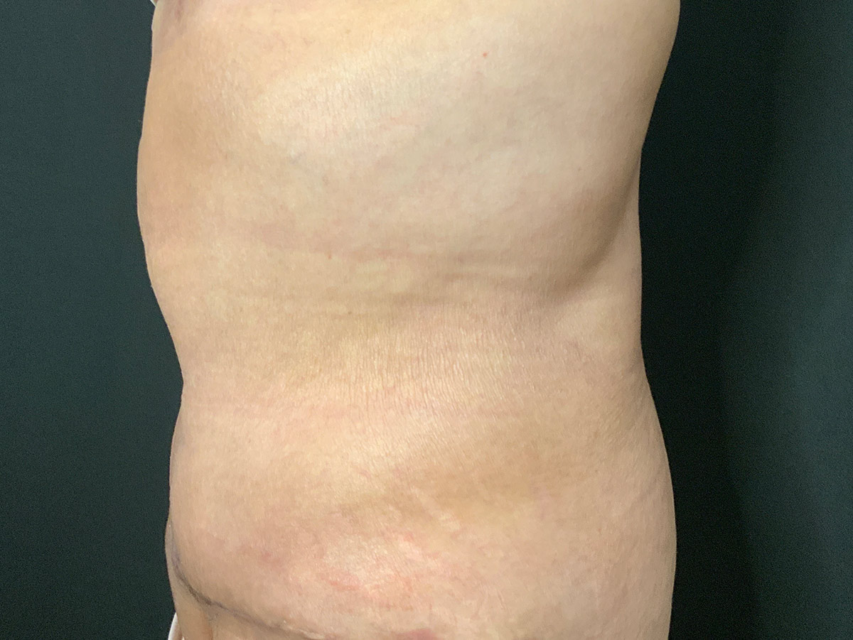 Case--2683 | After Fleur de Lis 2