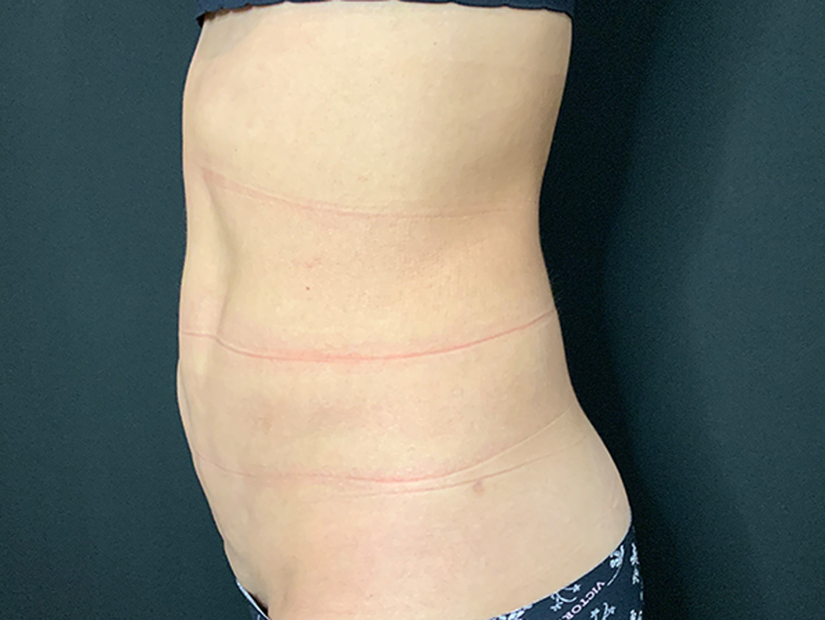 Case--1510 | After Liposuction 2