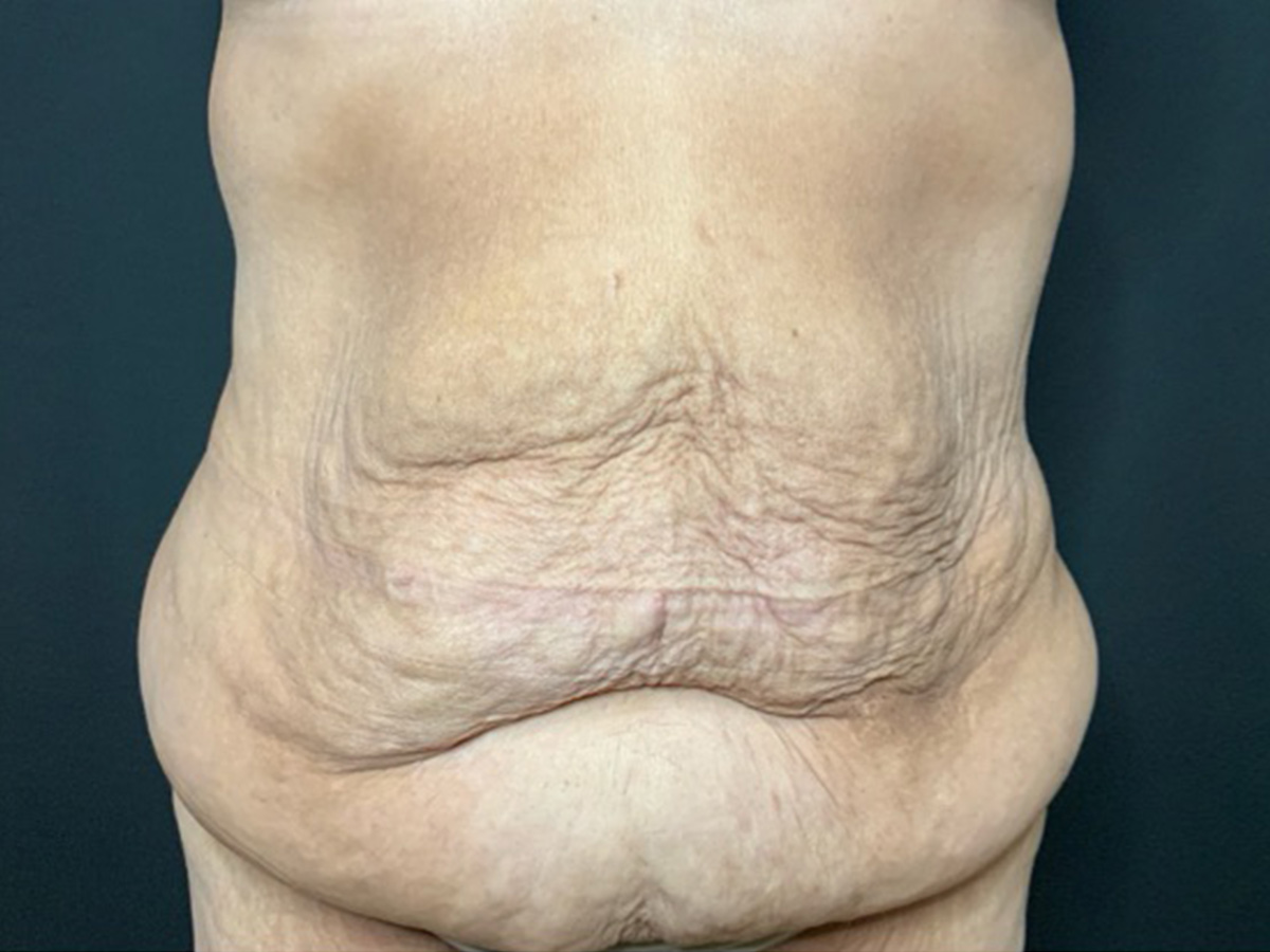 Case--2683 | Before Fleur de Lis