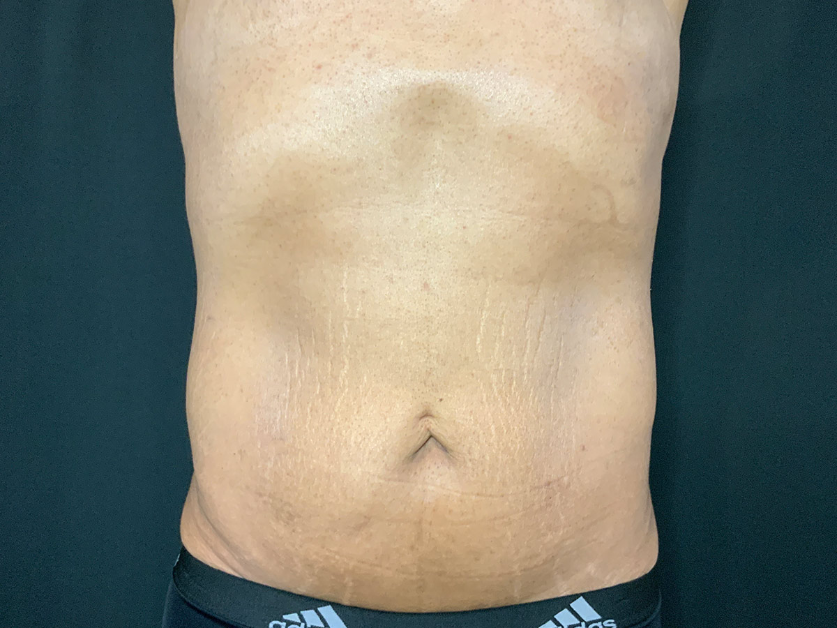 Case--4828 | Before Male Tummy Tuck
