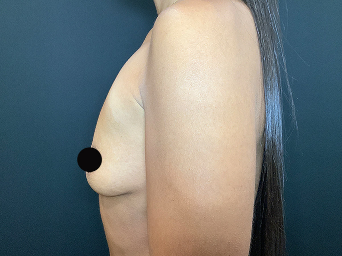 Case--2758 | Before Breast Augmentation 2