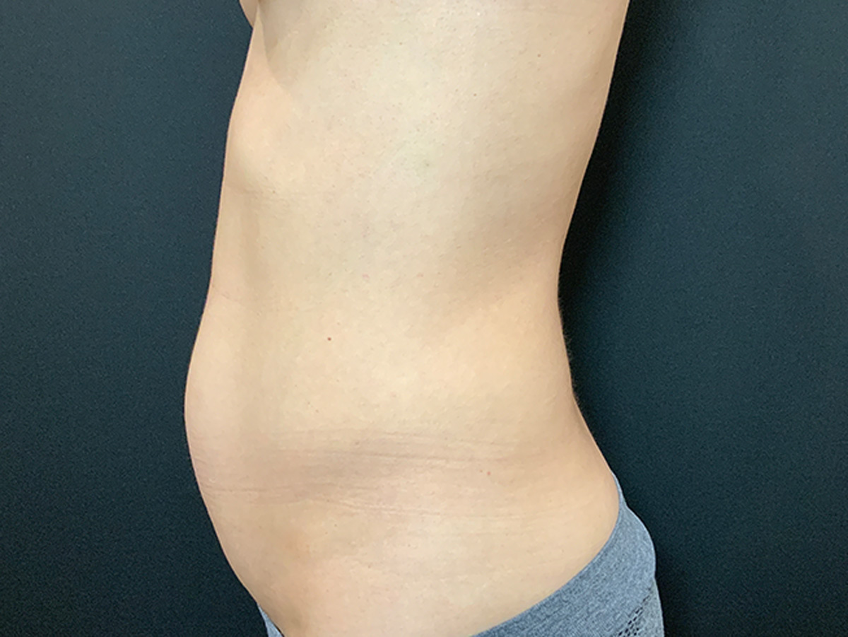 Case--1510 | Before Liposuction 2