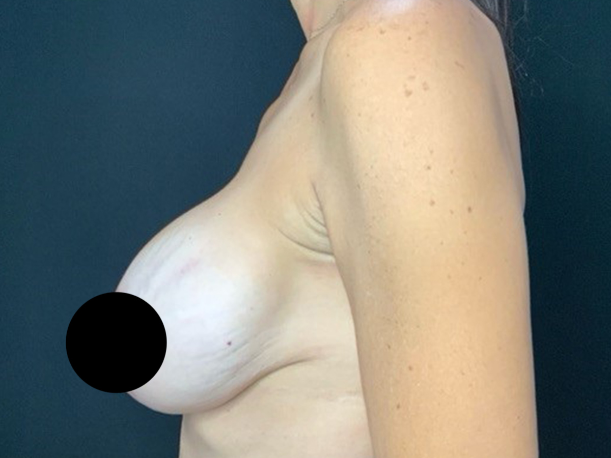 Case--3303 | Before Breast Revision 2