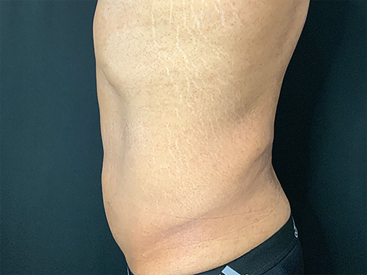 Case--4828 | Before Male Tummy Tuck 2