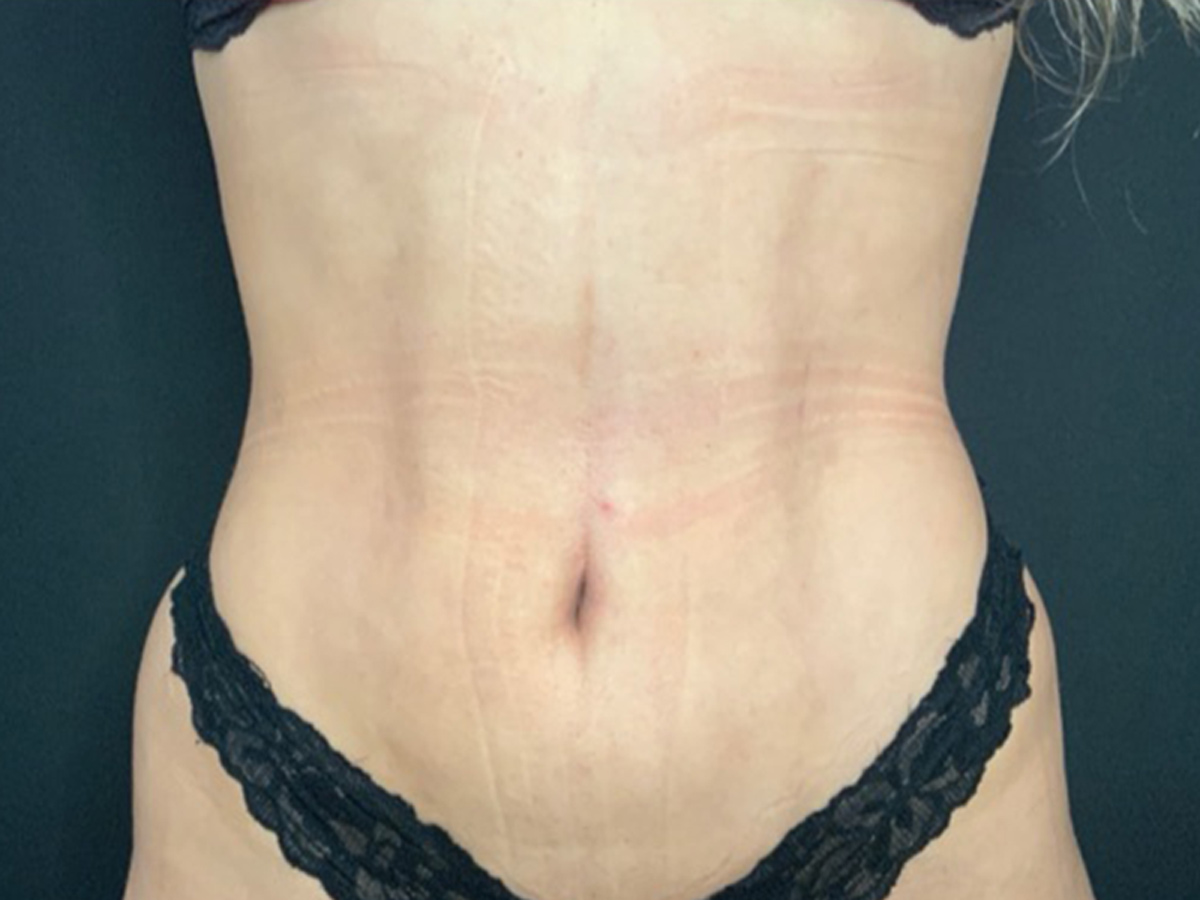 Case--8148 | After Liposuction