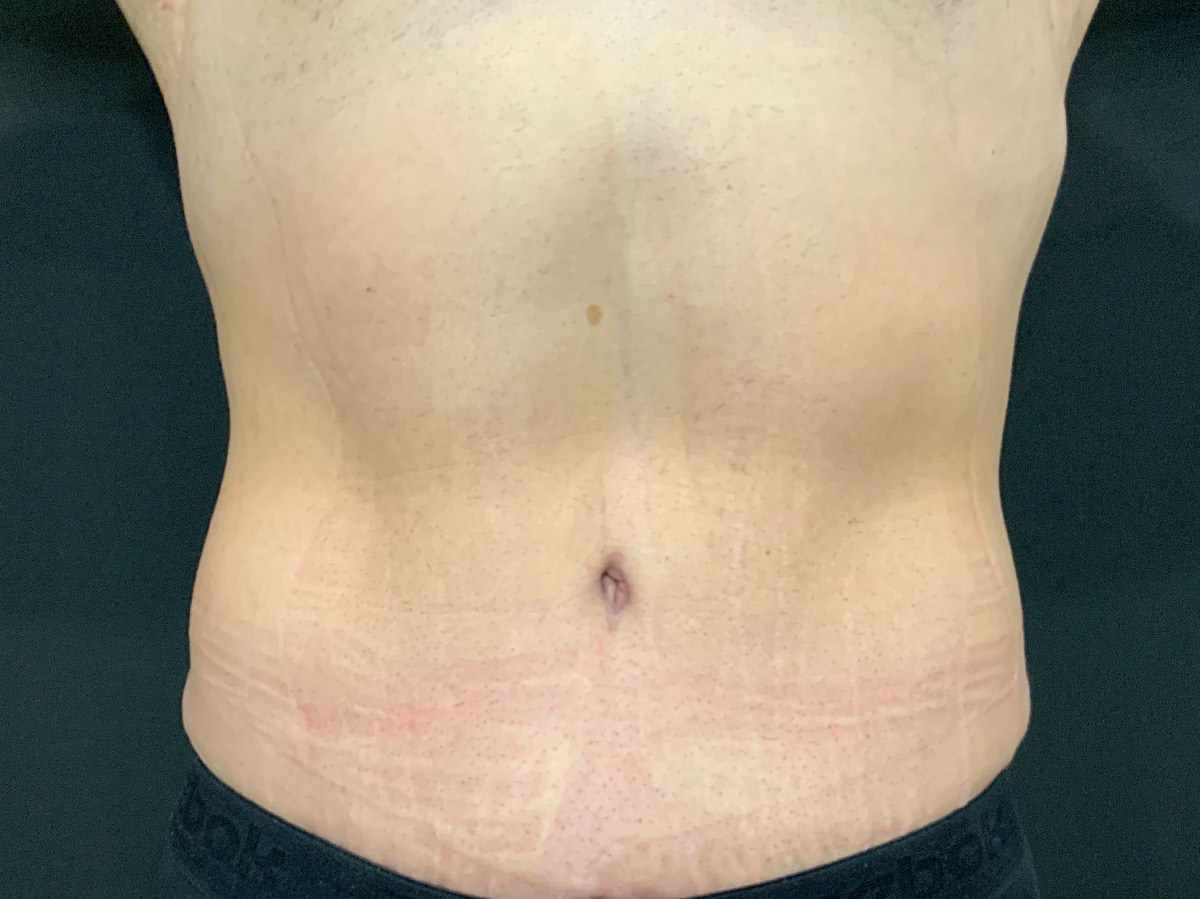 Case--1537 | After Male Tummy Tuck