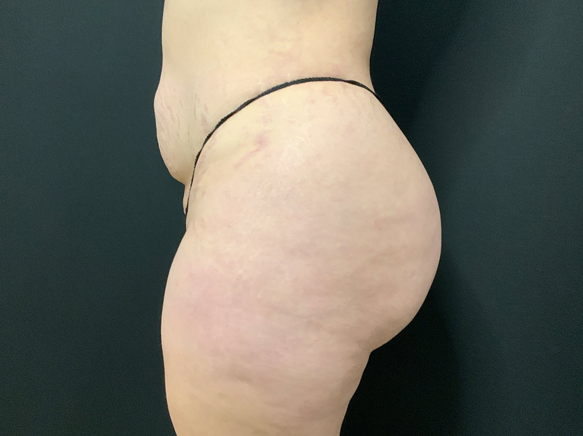 Case--2165 | After Brazilian Butt Lift 2