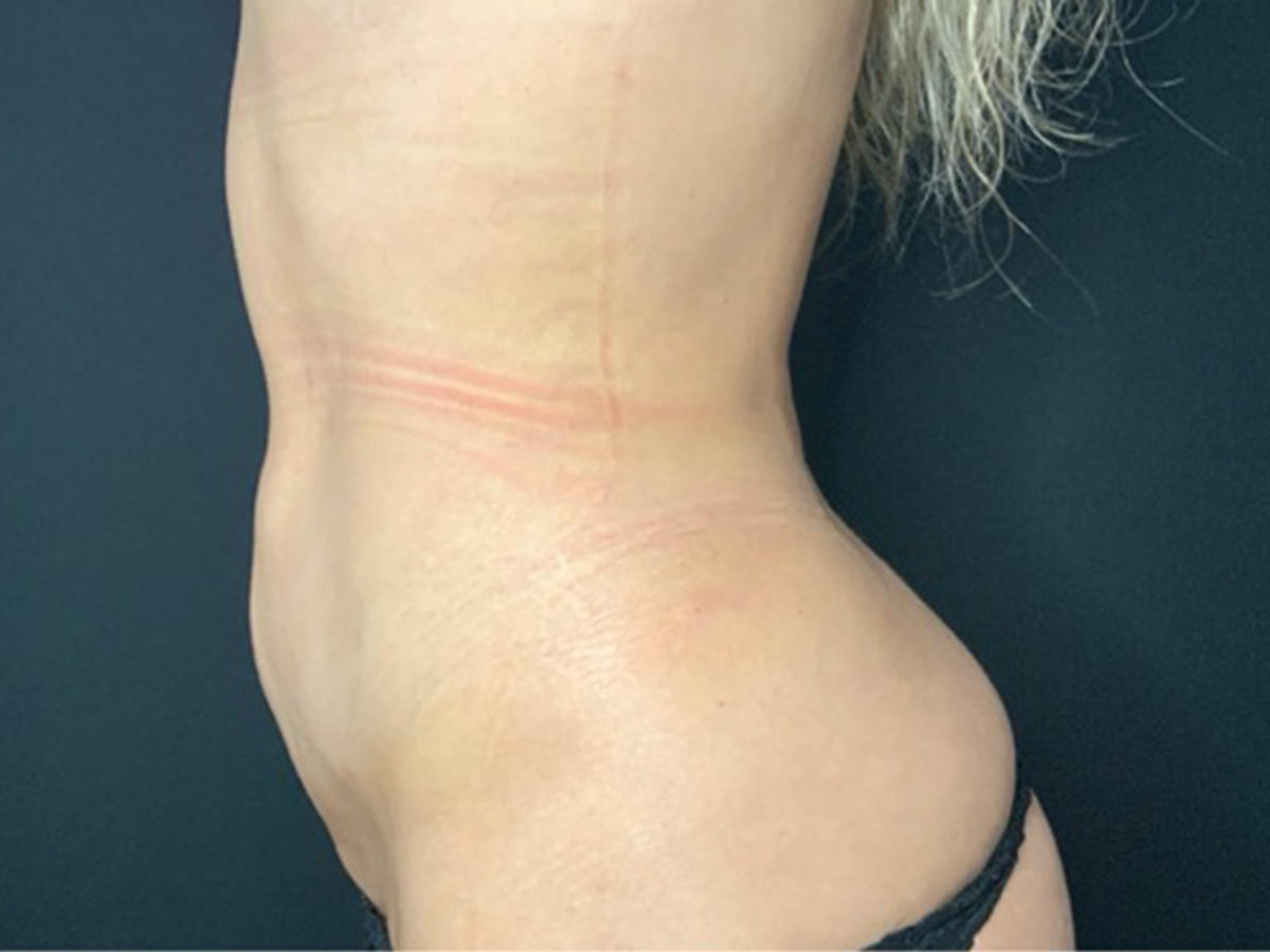 Case--8148 | After Liposuction 3