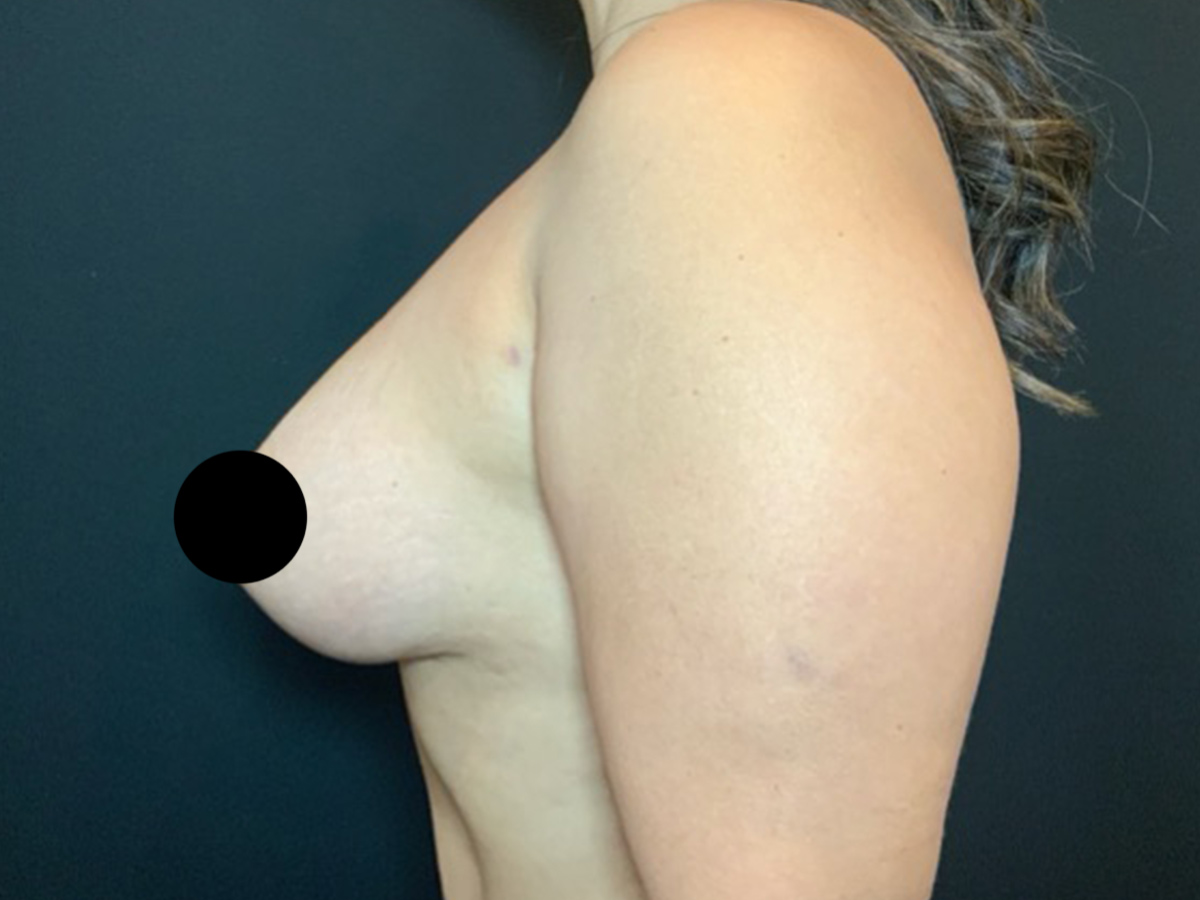 Case--1712 | After Mommy Makeover 3