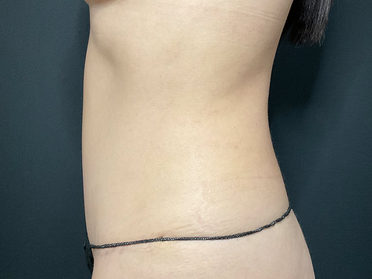 Case--8578 | After Tummy Tuck 2