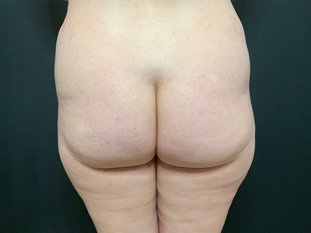 Case--2165 | Before Brazilian Butt Lift