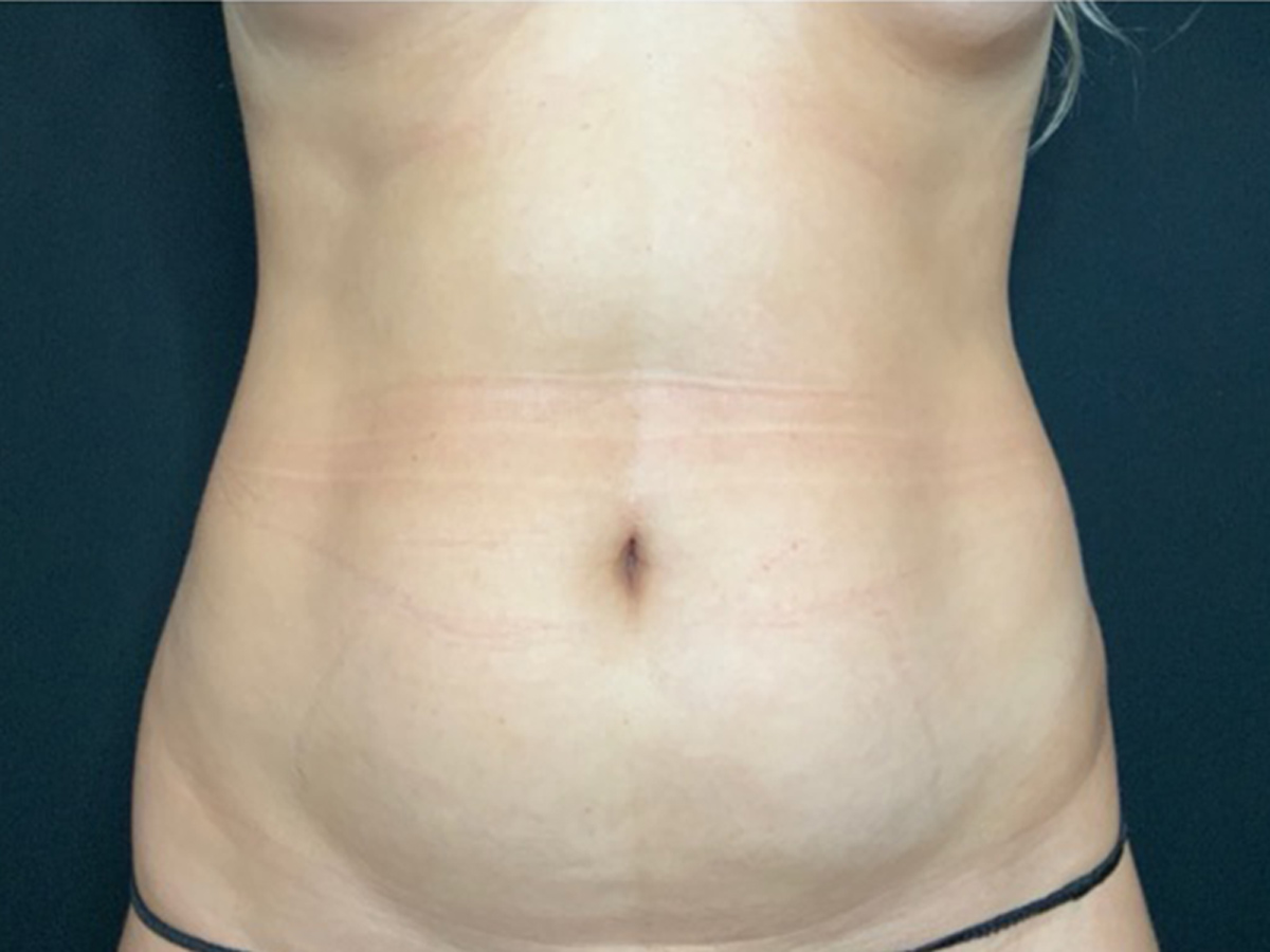 Case--8148 | Before Liposuction
