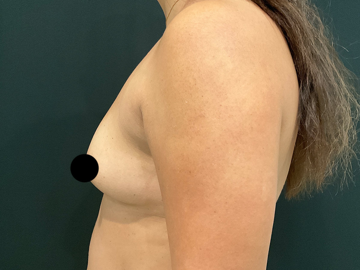 Case--6917 | Before Breast Augmentation 2