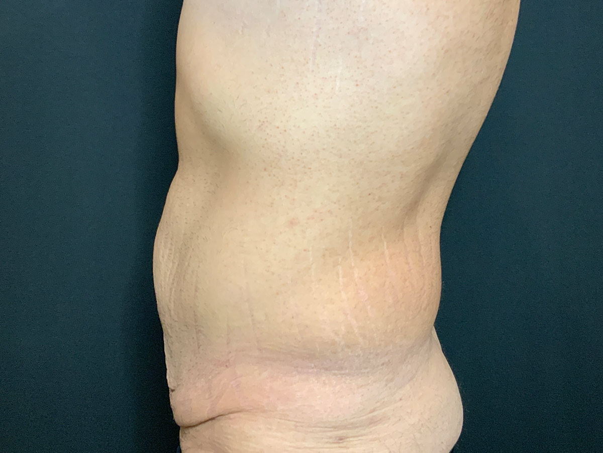 Case--1537 | Before Male Tummy Tuck 2