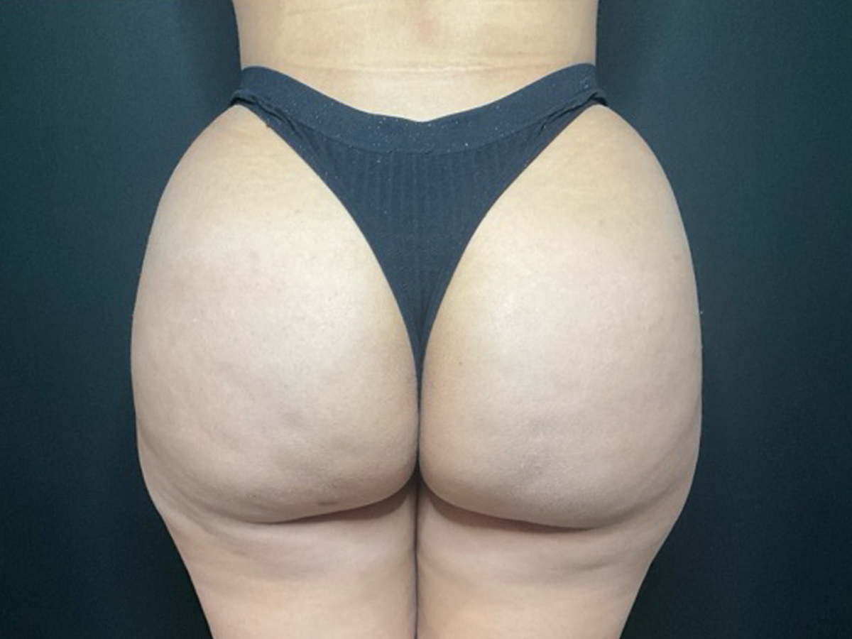 Case--2298 | After Brazilian Butt Lift