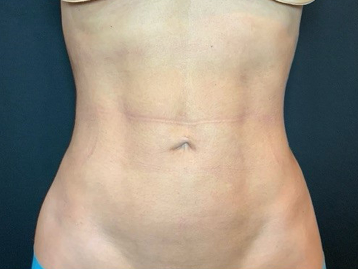 Case--5003 | After Liposuction