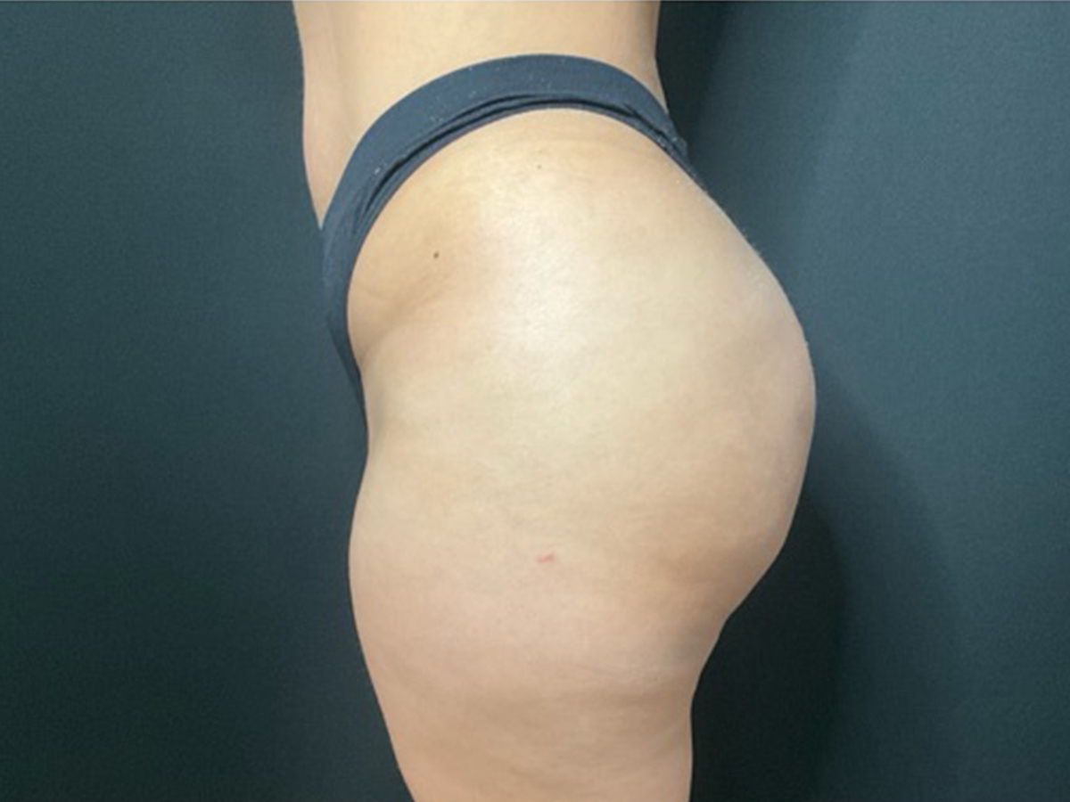 Case--2298 | After Brazilian Butt Lift 2