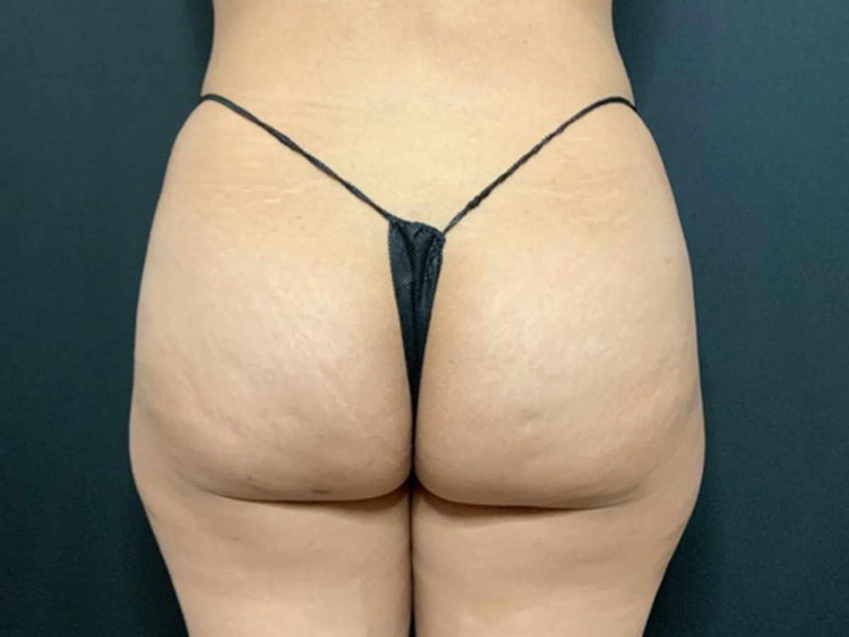Case--2298 | Before Brazilian Butt Lift