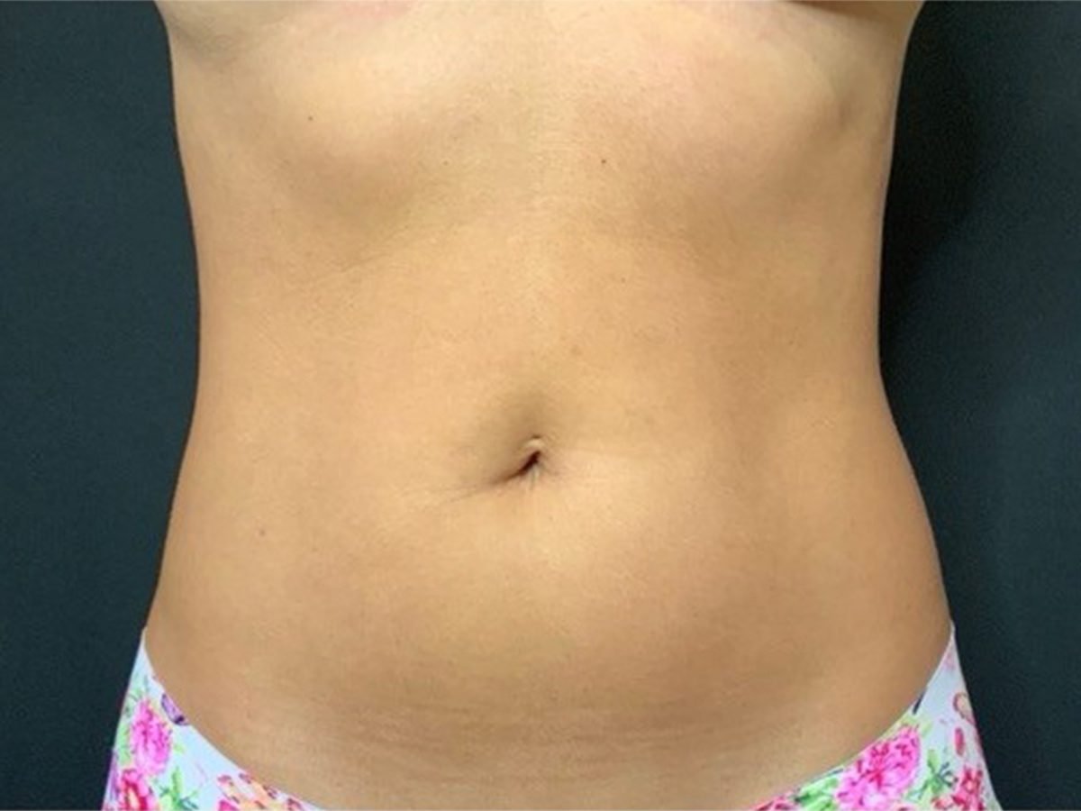 Case--5003 | Before Liposuction