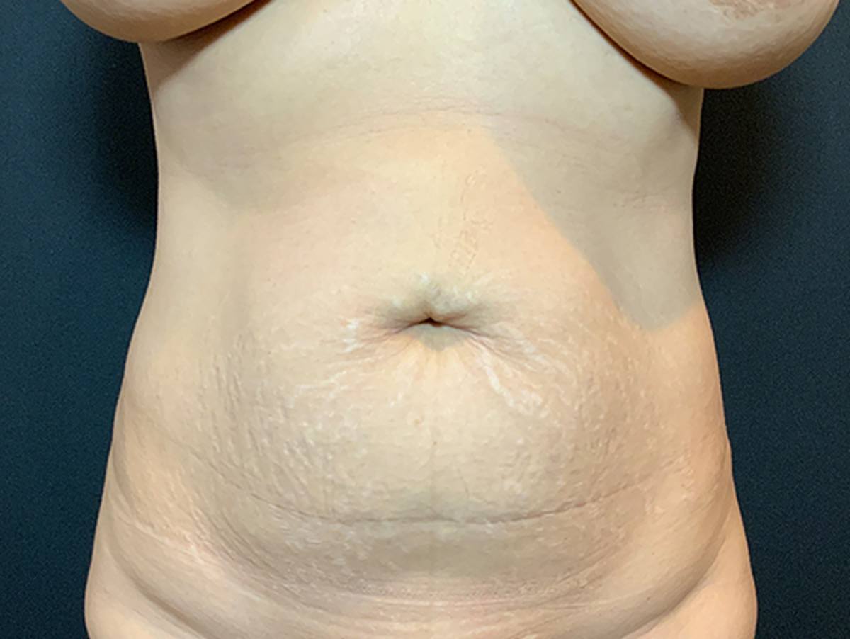 Case--5732 | Before Mommy Makeover 2