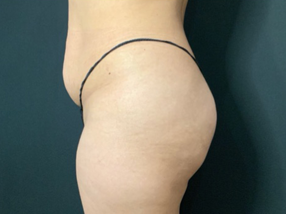 Case--2298 | Before Brazilian Butt Lift 2