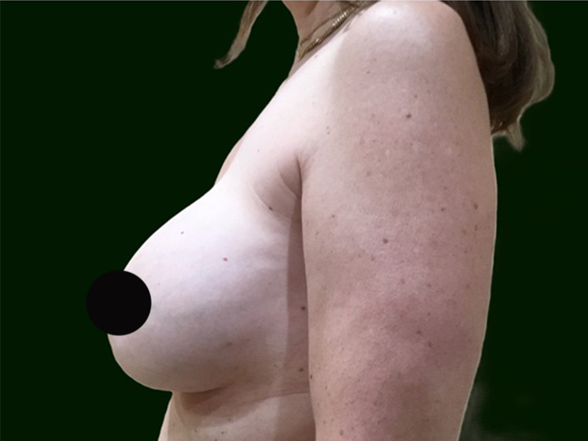 Case--7498 | Before Breast Revision 2