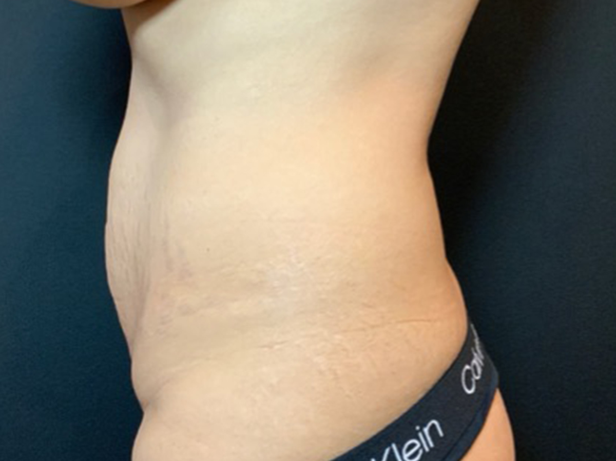 Case--5732 | Before Mommy Makeover 4