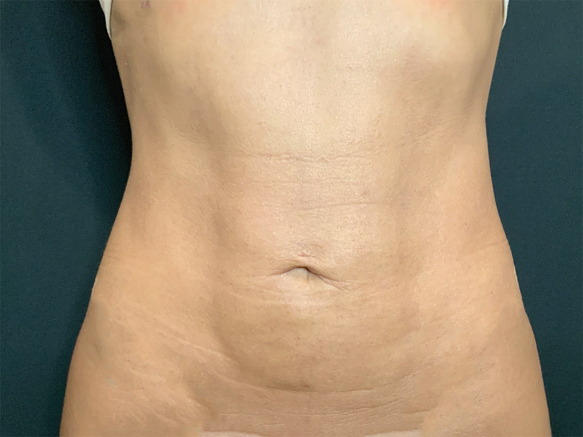 Case--9252 | After Liposuction