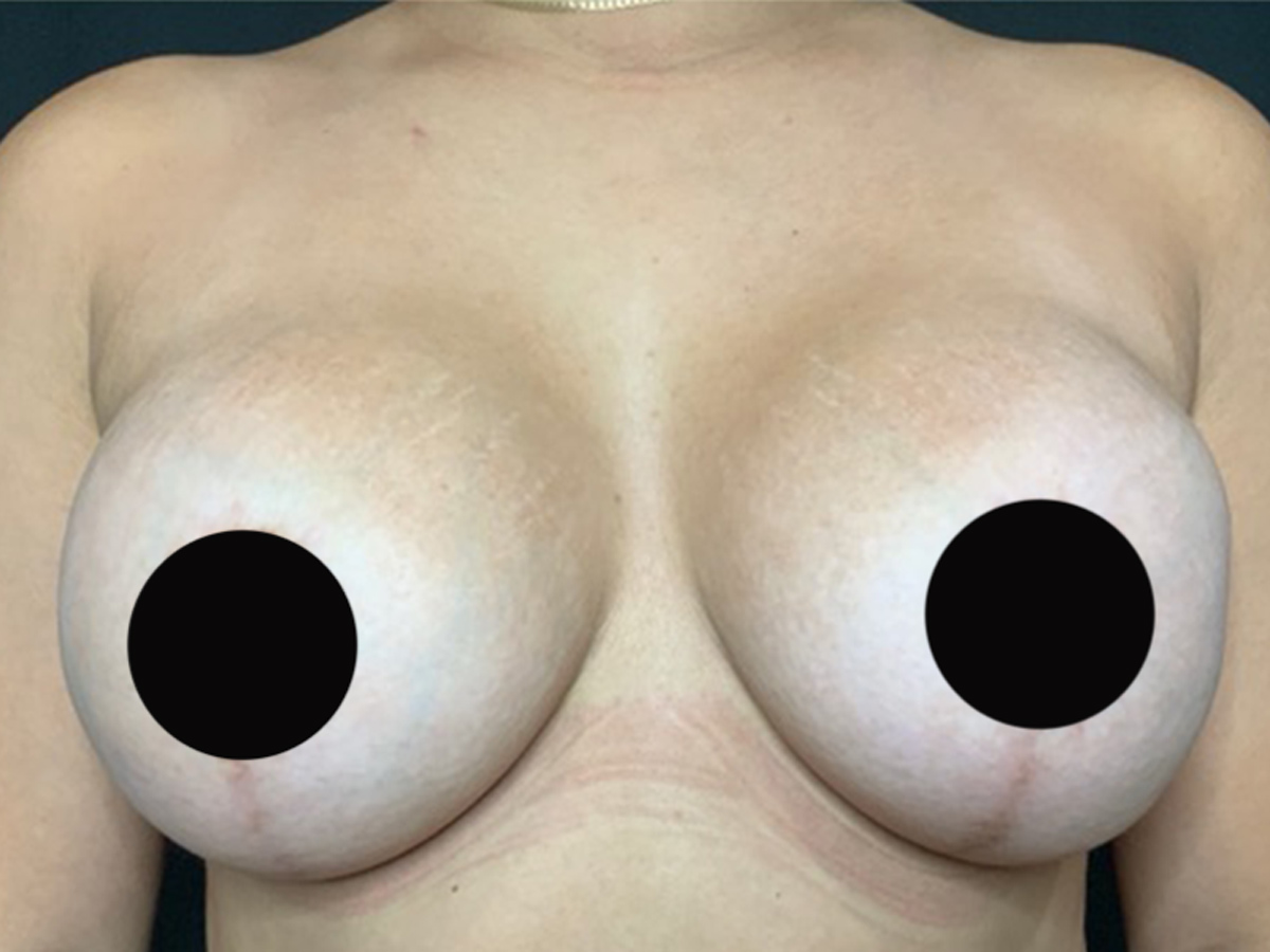 Case--7810 | After Breast Revision