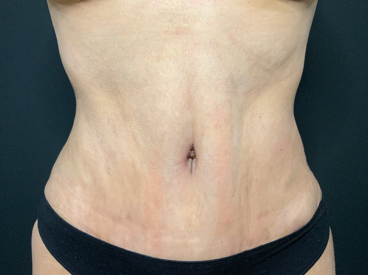 Case--2163 | After Tummy Tuck