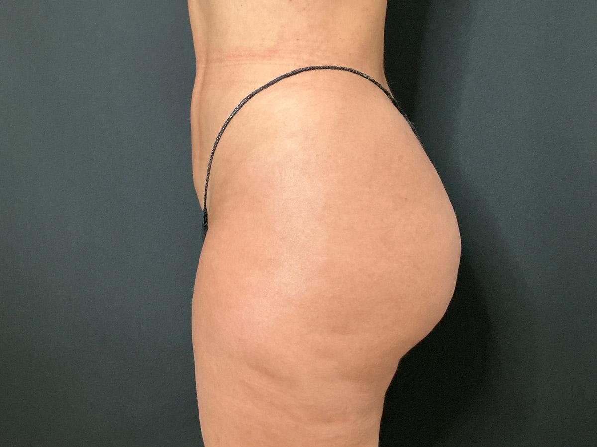 Case--2487 | After Brazilian Butt Lift 2