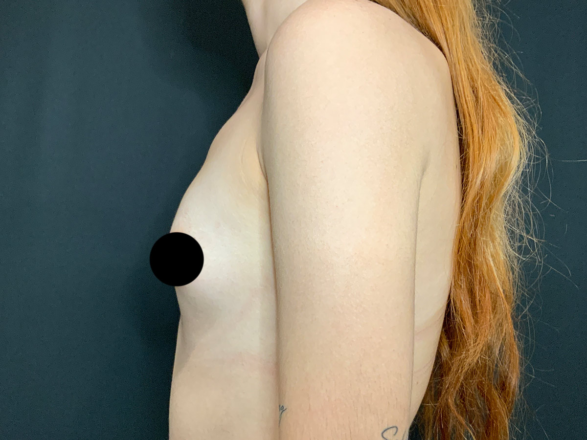 Case--1134 | Before Breast Augmentation 2