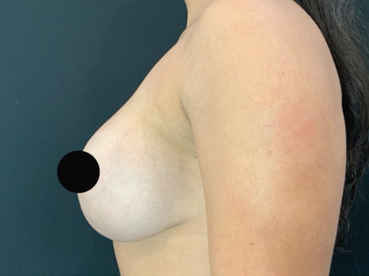 Case--7810 | Before Breast Revision 2