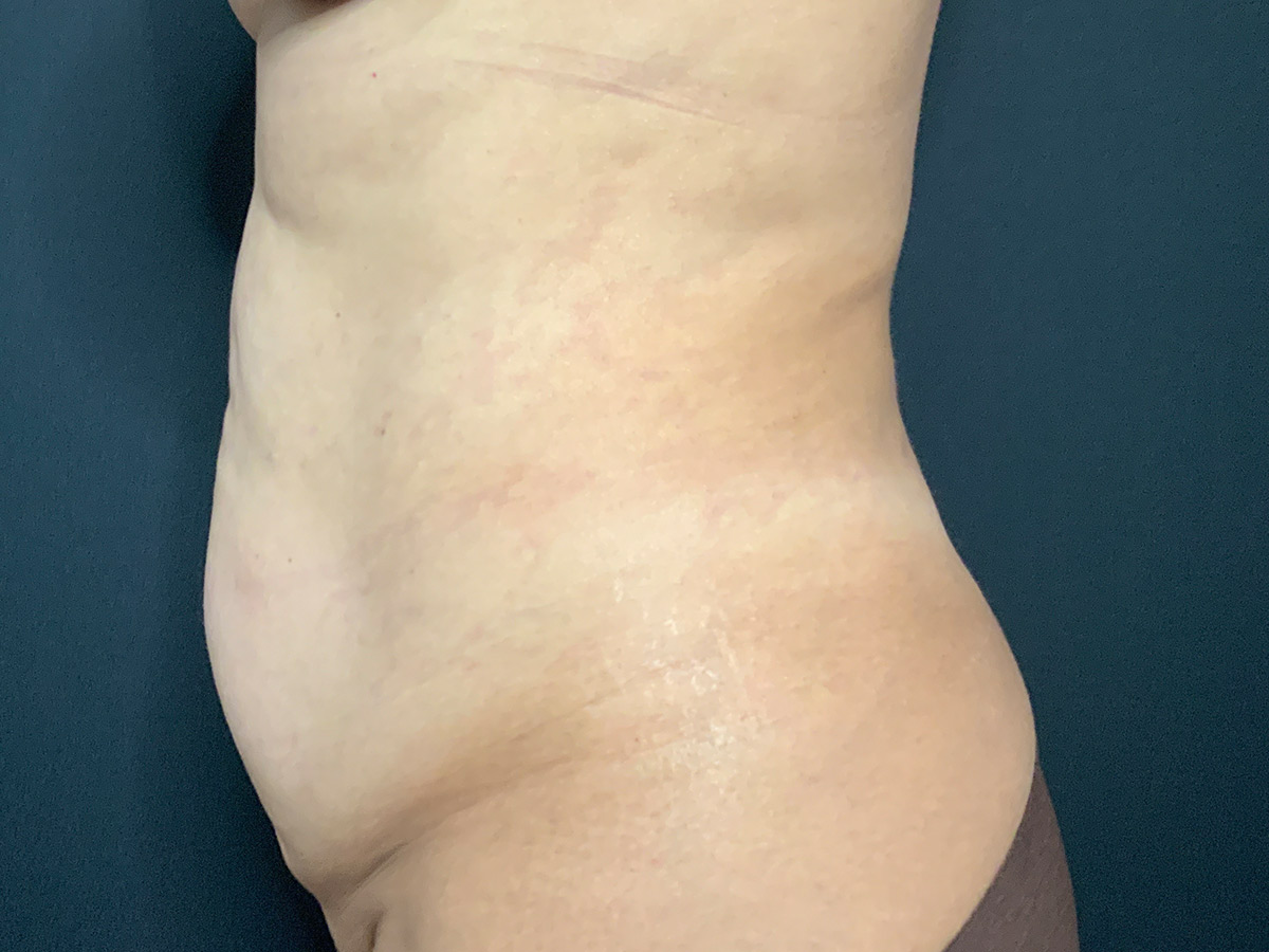 Case--2163 | Before Tummy Tuck 2