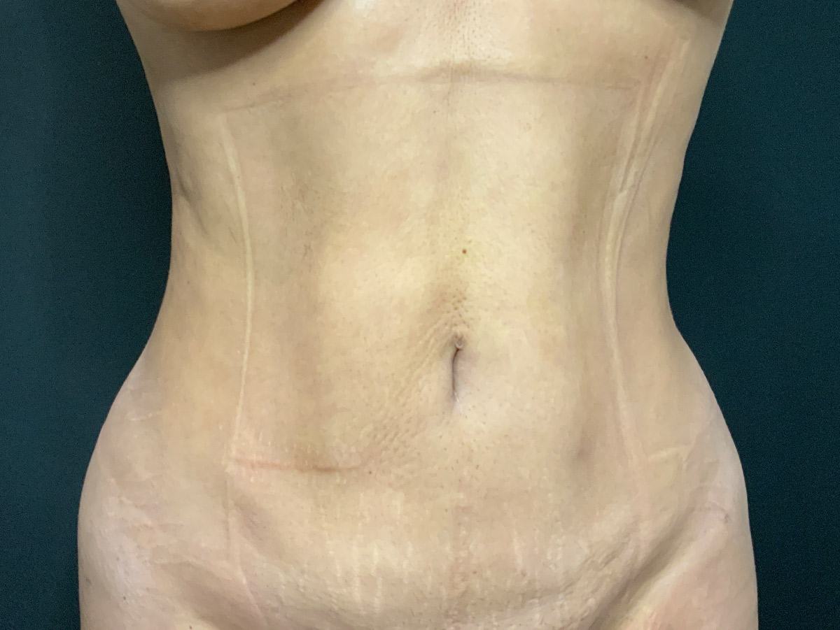 Case--4086 | After Liposuction