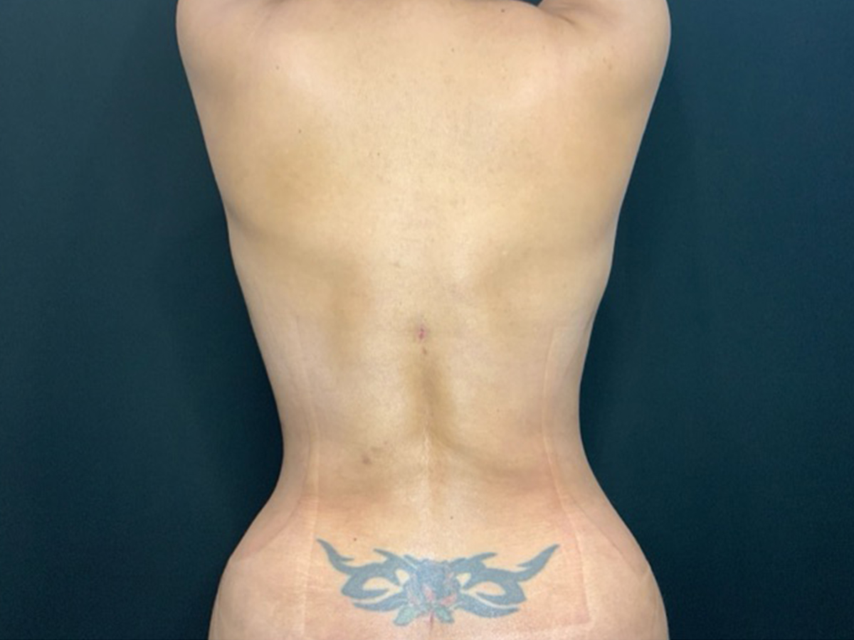 Case--4086 | After Liposuction 2