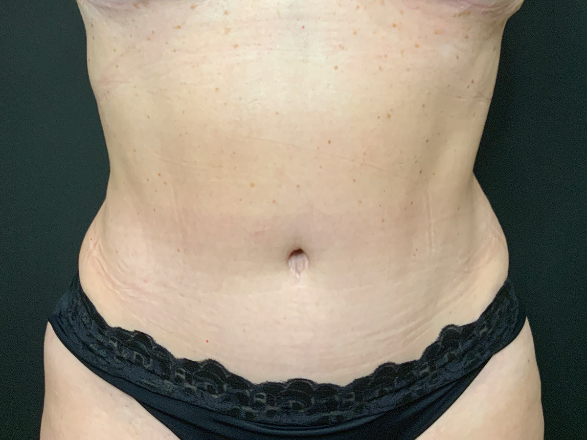 Case--6668 | After Tummy Tuck