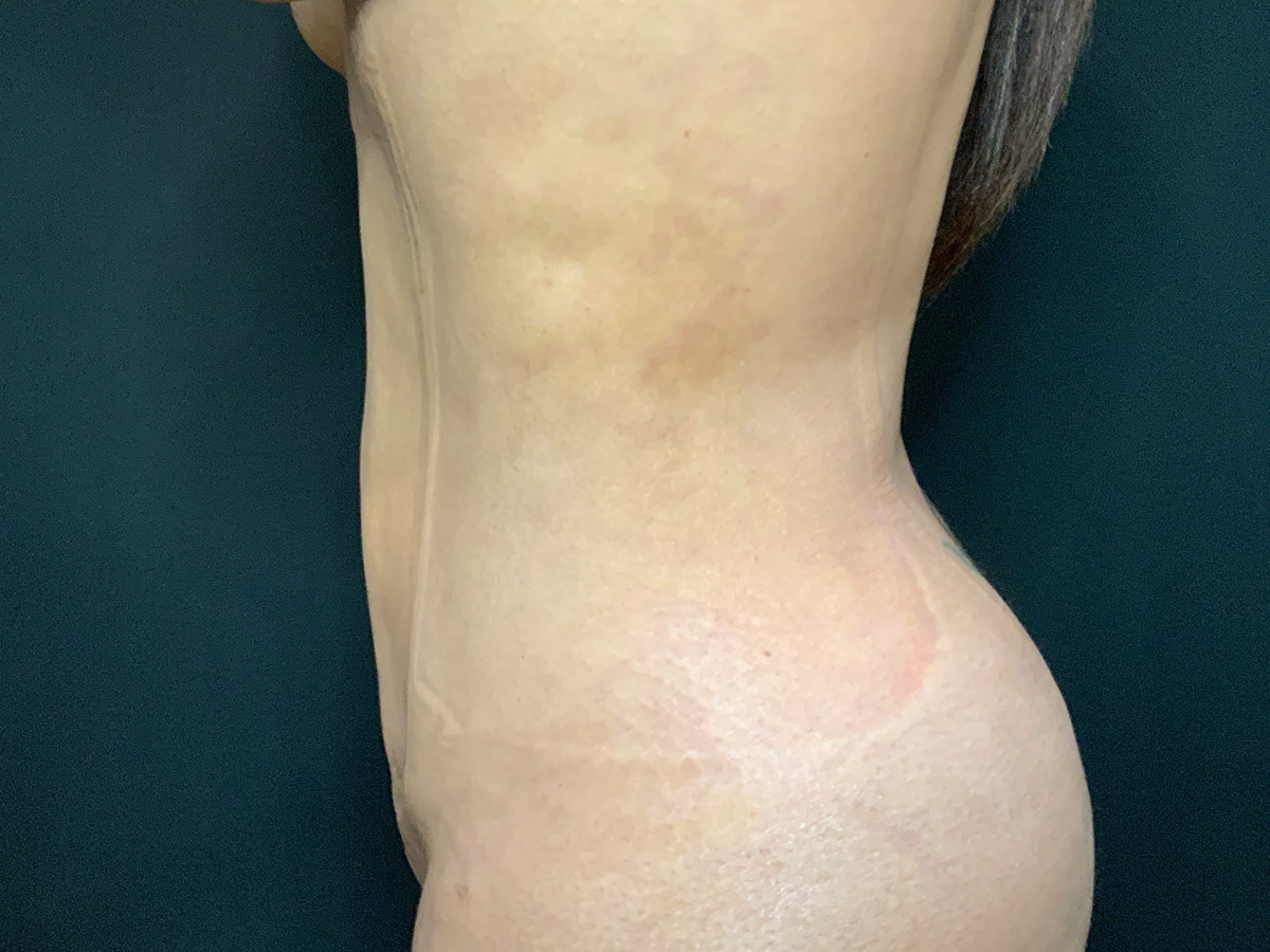 Case--4086 | After Liposuction 3