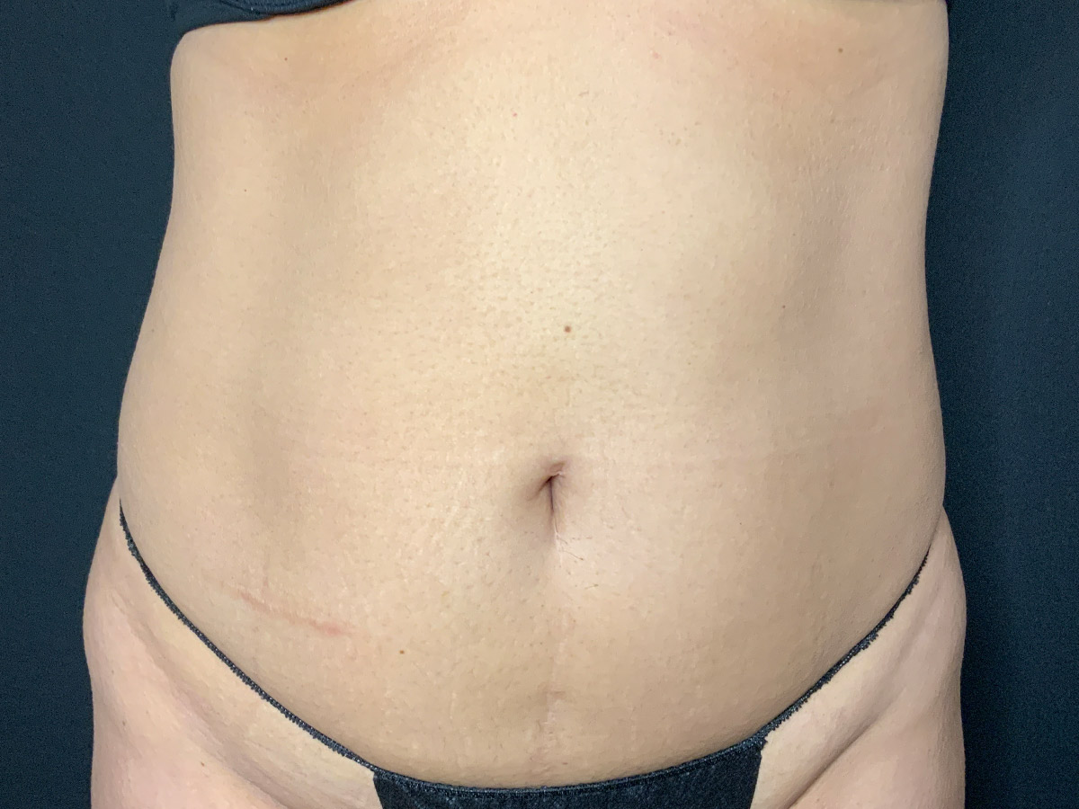 Case--4086 | Before Liposuction
