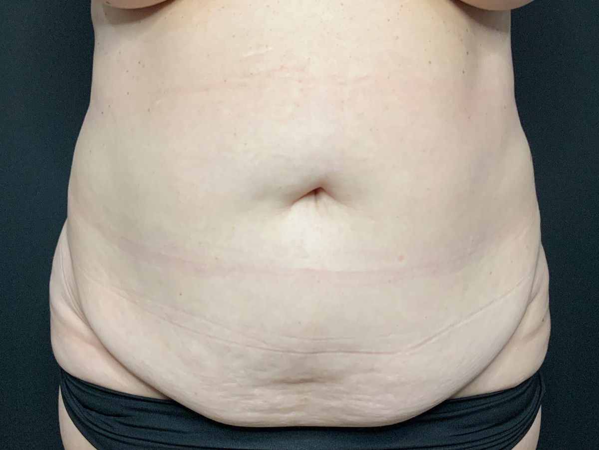 Case--6668 | Before Tummy Tuck