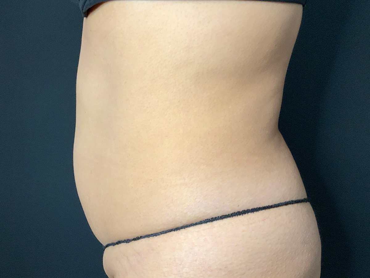 Case--4086 | Before Liposuction 3