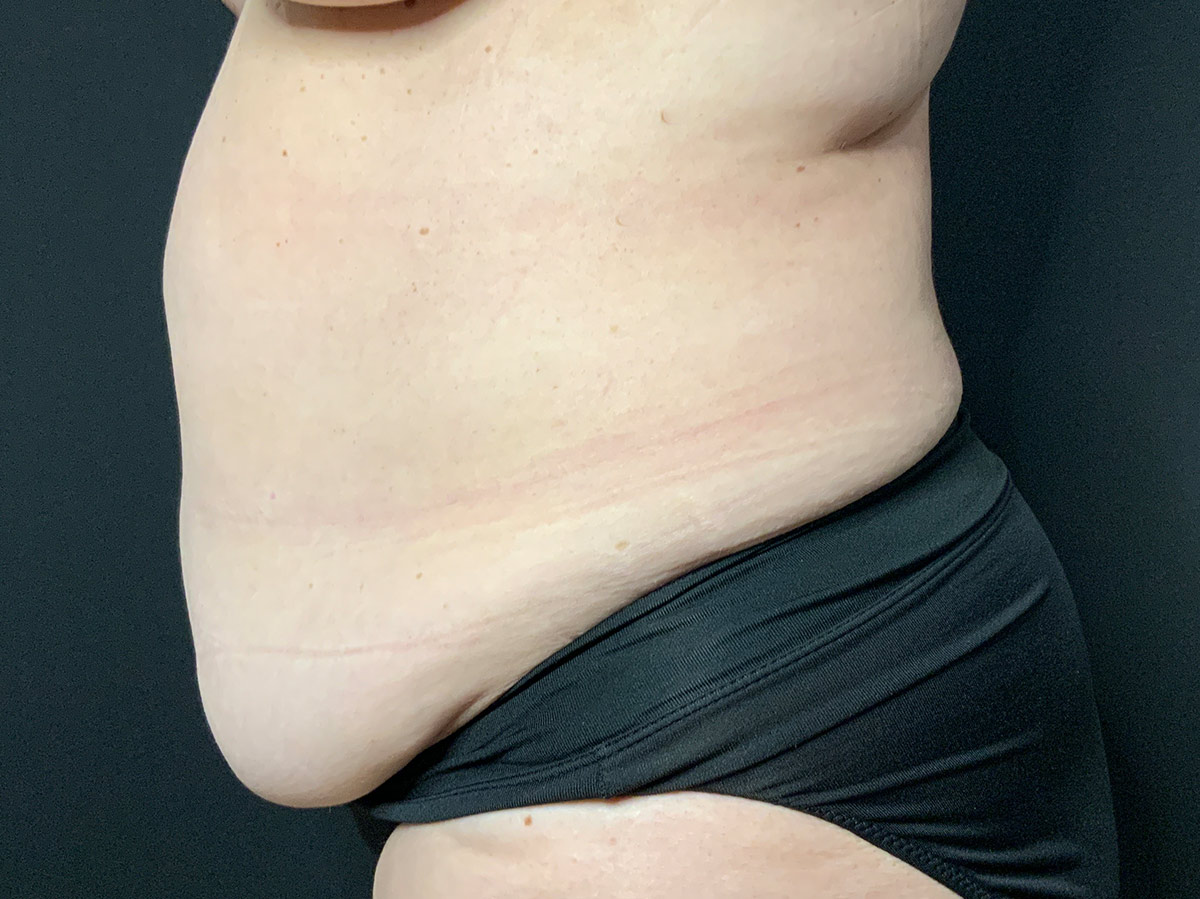 Case--6668 | Before Tummy Tuck 2