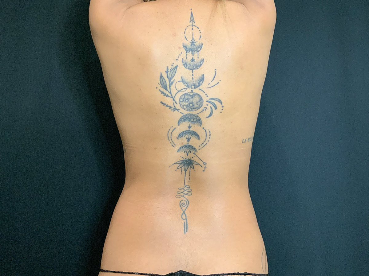 Case--6587 | Before Liposuction 2