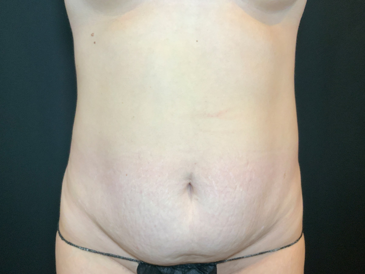 Case--8620 | Before Tummy Tuck
