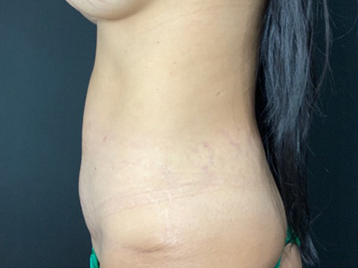 Case--6737 | Before Breast Revision 4