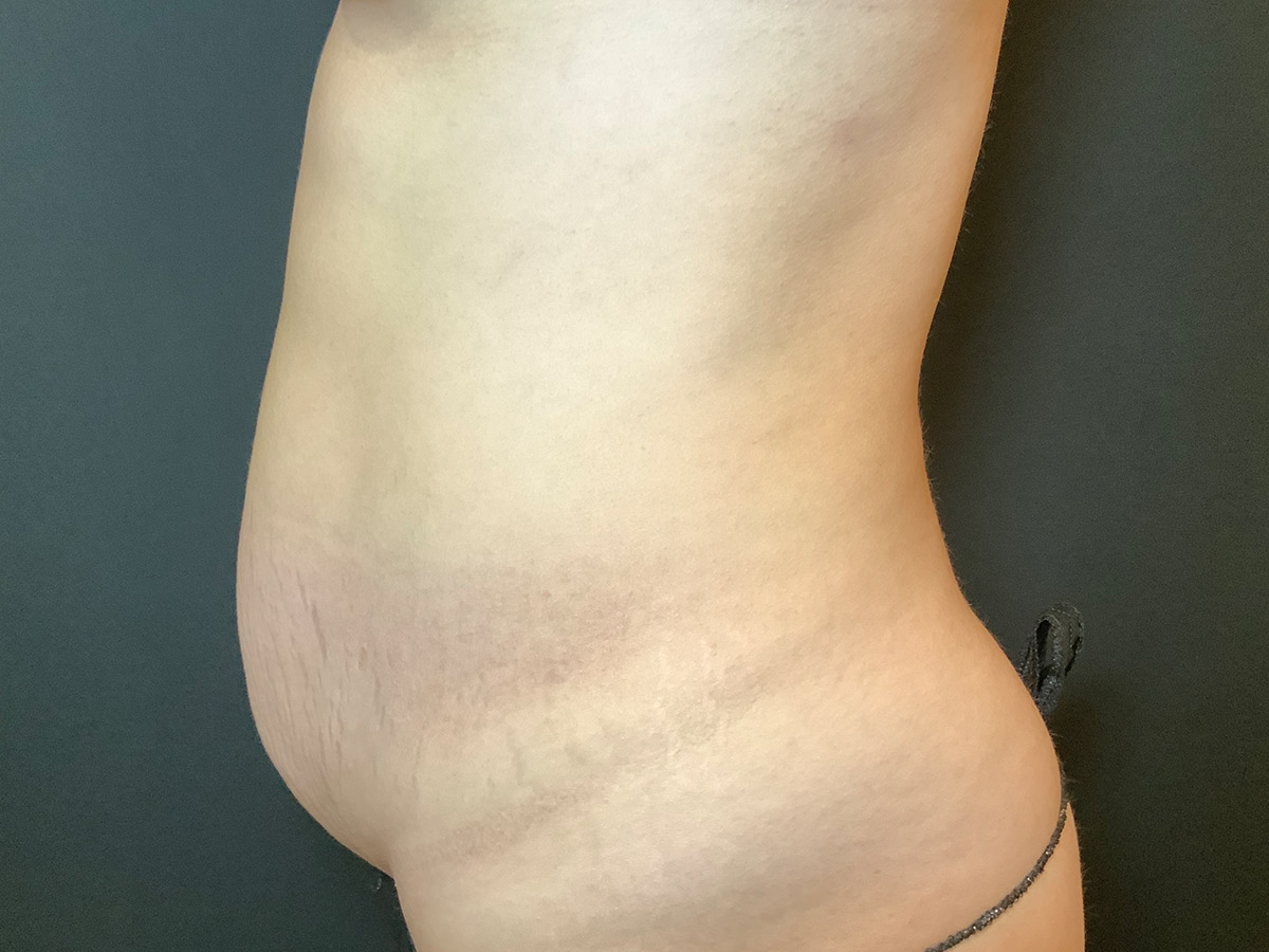 Case--8620 | Before Tummy Tuck 2